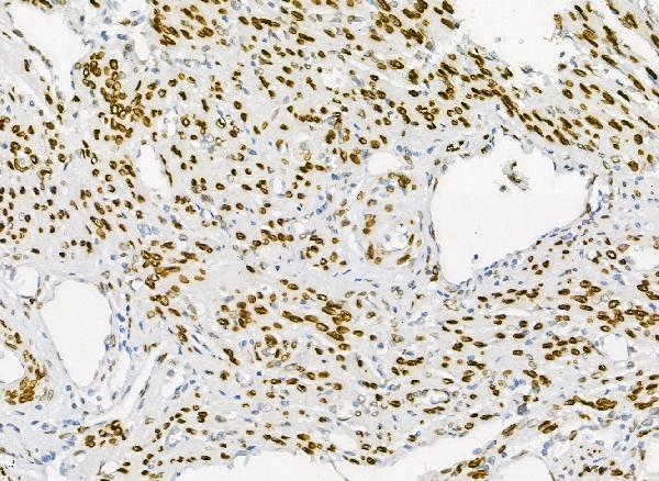 IHC analysis of Emerin using anti-Emerin antibody (A00714). Emerin was detected in paraffin-embedded section of human endometrial carcinoma tissues. Heat mediated antigen retrieval was performed in citrate buffer (pH6, epitope retrieval solution) for 20 mins. The tissue section was blocked with 10% goat serum. The tissue section was then incubated with 2μg/ml rabbit anti-Emerin Antibody (A00714) overnight at 4°C. Biotinylated goat anti-rabbit IgG was used as secondary antibody and incubated for 30 minutes at 37°C. The tissue section was developed using Strepavidin-Biotin-Complex (SABC)(Catalog # SA1022) with DAB as the chromogen.