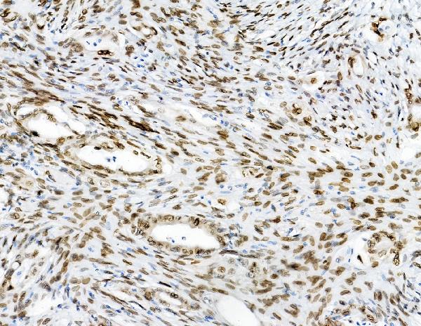 IHC analysis of Emerin using anti-Emerin antibody (A00714). Emerin was detected in paraffin-embedded section of human colon cancer tissues. Heat mediated antigen retrieval was performed in citrate buffer (pH6, epitope retrieval solution) for 20 mins. The tissue section was blocked with 10% goat serum. The tissue section was then incubated with 1μg/ml rabbit anti-Emerin Antibody (A00714) overnight at 4°C. Biotinylated goat anti-rabbit IgG was used as secondary antibody and incubated for 30 minutes at 37°C. The tissue section was developed using Strepavidin-Biotin-Complex (SABC)(Catalog # SA1022) with DAB as the chromogen.