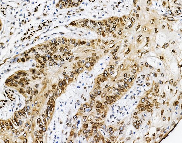 IHC analysis of Emerin using anti-Emerin antibody (A00714). Emerin was detected in paraffin-embedded section of human oesophagus squama cancer tissues. Heat mediated antigen retrieval was performed in citrate buffer (pH6, epitope retrieval solution) for 20 mins. The tissue section was blocked with 10% goat serum. The tissue section was then incubated with 1μg/ml rabbit anti-Emerin Antibody (A00714) overnight at 4°C. Biotinylated goat anti-rabbit IgG was used as secondary antibody and incubated for 30 minutes at 37°C. The tissue section was developed using Strepavidin-Biotin-Complex (SABC)(Catalog # SA1022) with DAB as the chromogen.