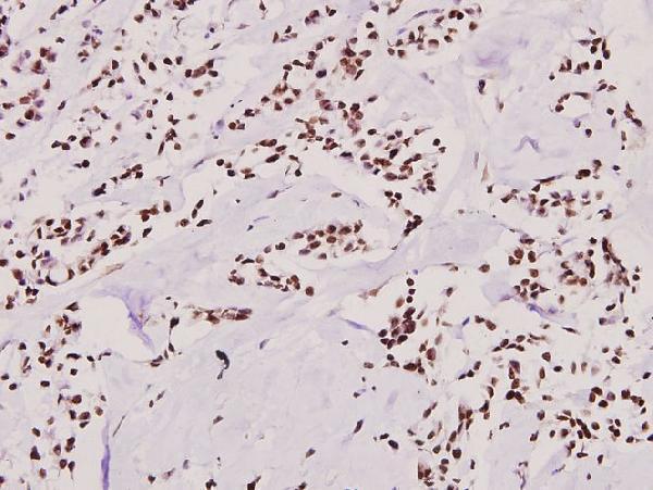 Immunohistochemistry (IHC) analyzes of Snail1 (A242) pAb in paraffin-embedded human breast carcinoma tissue at 1:100