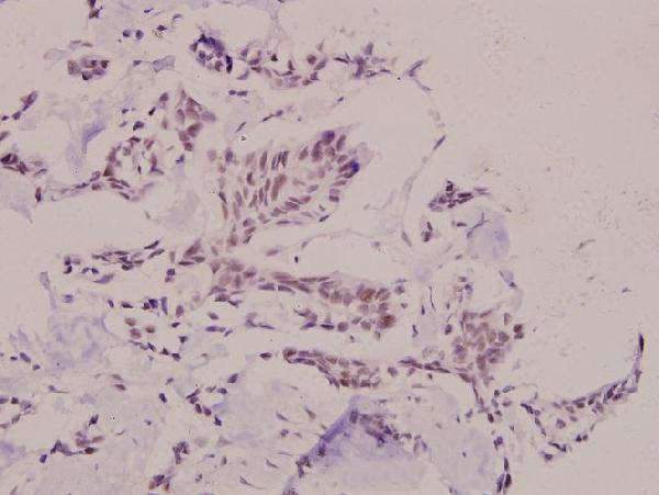 Immunohistochemistry (IHC) analyzes of Snail1 (phospho-S246) polyclonal antibody in paraffin-embedded human breast carcinoma tissue at 1:100
