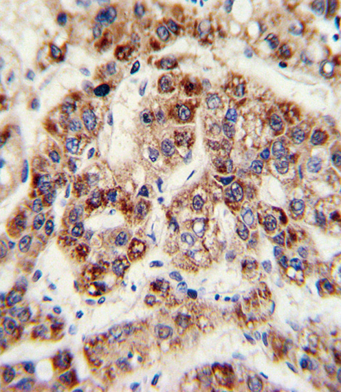 Formalin-fixed and paraffin-embedded human hepatoarcinoma with OTC Antibody (Center), which was peroxidase-conjugated to the secondary antibody, followed by DAB staining