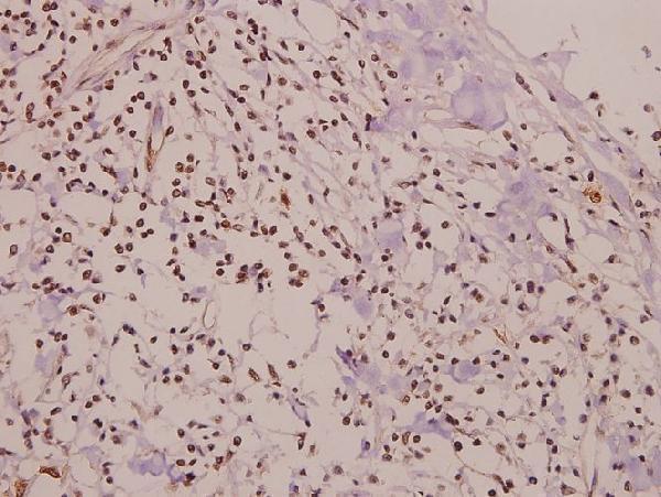 Immunohistochemistry (IHC) analyzes of p-Smad1 (S465) pAb in paraffin-embedded human colorectal carcinoma tissue at 1:50