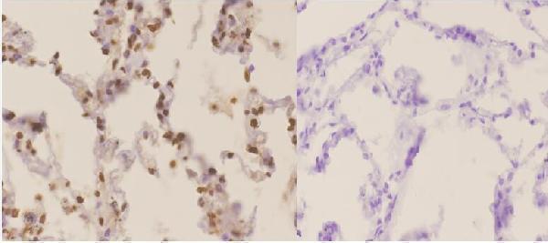 Immunohistochemistry (IHC) analyzes of Nibrin (T337) pAb in paraffin-embedded human Lung carcinoma tissue at 1:50