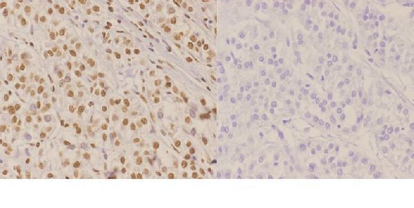 Immunohistochemistry (IHC) analyzes of Nibrin (T337) pAb in paraffin-embedded human liver carcinoma tissue at 1:50