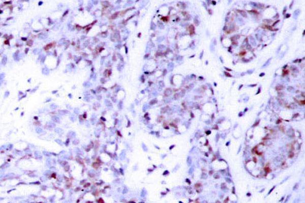 Immunohistochemistry (IHC) analyzes of STAT4 (E687) pAb in paraffin-embedded human breast carcinoma tissue