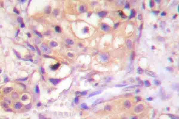 Immunohistochemistry (IHC) analyzes of p-PKC-pan (αT497) pAb in paraffin-embedded human breast carcinoma tissue