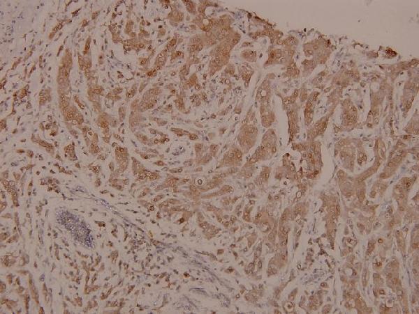 Immunohistochemistry (IHC) analyzes of p-PKC α (T505) pAb in paraffin-embedded human breast carcinoma tissue at 1:100