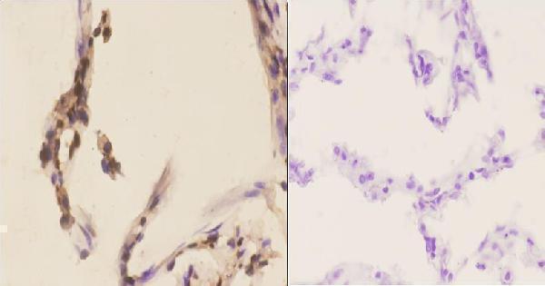 Immunohistochemistry (IHC) analyzes of p-PKC α (T638) pAb in paraffin-embedded human lung carcinoma tissue at 1:50