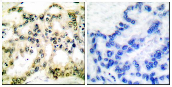 Immunohistochemistry analysis of paraffin-embedded human lung carcinoma, using Cyclin B1 (Phospho-Ser126) Antibody