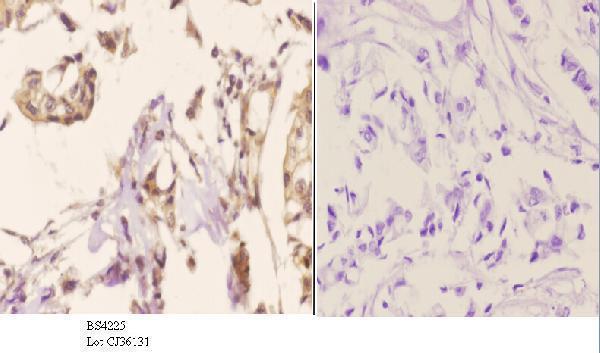 Immunohistochemistry (IHC) analyzes of p-Cyclin B1 (S126) pAb in paraffin-embedded human breast carcinoma tissue at 1:50