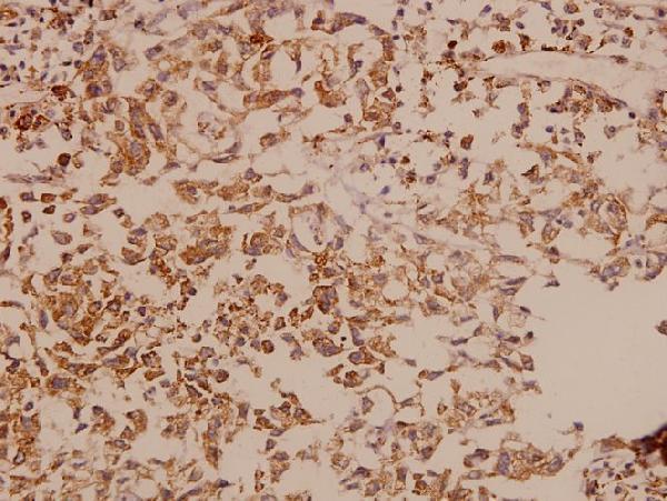 Immunohistochemistry (IHC) analyzes of DDX3 (L318) pAb in paraffin-embedded human breast carcinoma tissue at 1:50