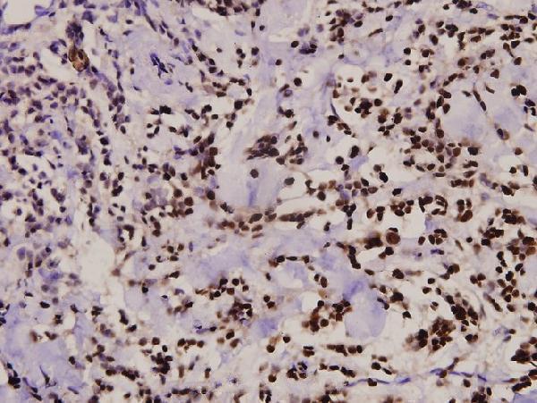 Immunohistochemistry (IHC) analyzes of ZAP70 (S313) pAb in paraffin-embedded human breast carcinoma tissue at 1:100