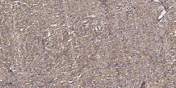 Immunohistochemical analysis of paraffin-embedded human small intestinal carcinoma tissue