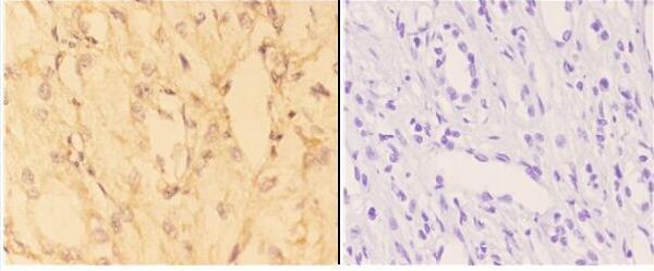 Immunohistochemistry (IHC) analyzes of ACE2 (K465) pAb bin paraffin-embedded human kidney carcinoma tissue at 1:50,showing cytoplasmic and membrane staining