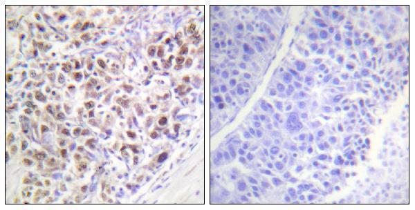 Immunohistochemistry analysis of paraffin-embedded human liver carcinoma, using AurB (Phospho-Thr232) Antibody