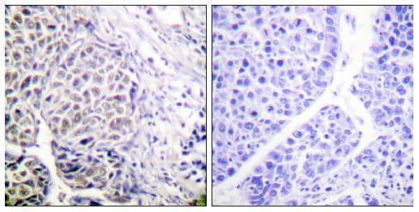 Immunohistochemistry analysis of paraffin-embedded human liver carcinoma, using AurB (Phospho-Tyr12) Antibody
