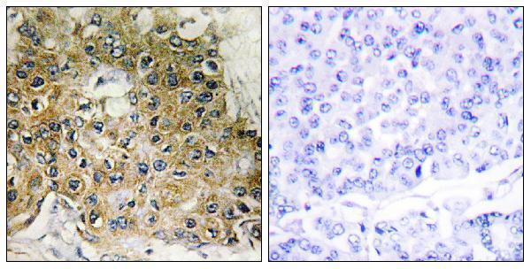 Immunohistochemistry analysis of paraffin-embedded human breast carcinoma, using Integrin beta1 (Phospho-Thr789) Antibody