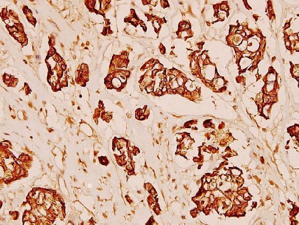 Immunohistochemistry (IHC) analyzes of MMP-3 (S453) pAb in paraffin-embedded human breast carcinoma tissue at 1:100