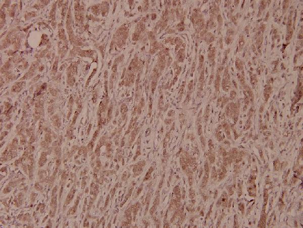 Immunohistochemistry (IHC) analyzes of GSK3β (S2) pAb in paraffin-embedded human breast carcinoma tissue at 1:100