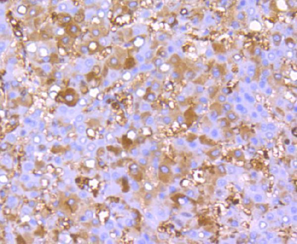 Immunohistochemical analysis of paraffin-embedded human liver cancer tissue using anti-FGF21 antibody