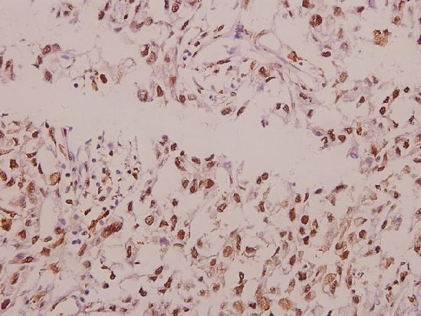 Immunohistochemistry (IHC) analyzes of PTGS1 (S585) pAb in paraffin-embedded human colorectal carcinoma tissue at 1:50