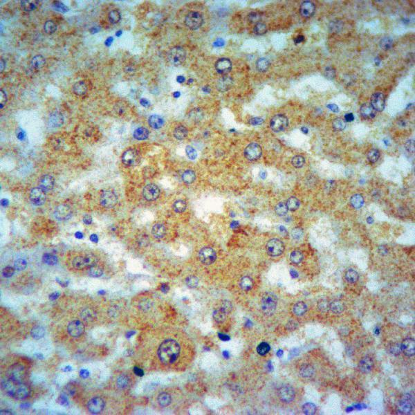 Immunohistochemistry of paraffin-embedded Human Liver cancer using ATG12 antibody at dilution of 1:50