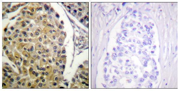 Immunohistochemistry analysis of paraffin-embedded human breast carcinoma, using PKC delta (Phospho-Tyr313) Antibody