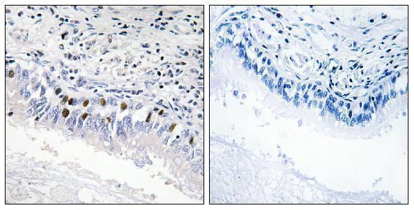 Immunohistochemistry analysis of paraffin-embedded human lung carcinoma, using MED12 Antibody