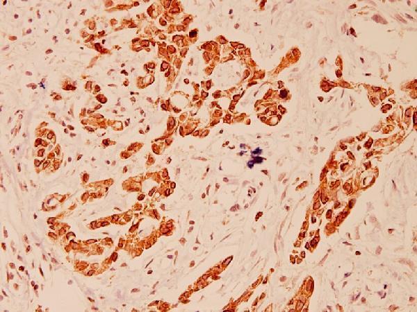 Immunohistochemistry (IHC) analyzes of EEF2 (A50) pAb in paraffin-embedded human breast carcinoma tissue at 1:100