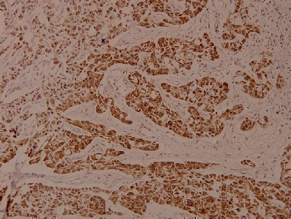 Immunohistochemistry (IHC) analyzes of p-EEF2 (T56) pAb in paraffin-embedded human breast carcinoma tissue at 1:100