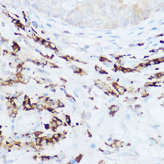 Immunohistochemistry of paraffin-embedded human breast cancer using NEDD9 Rabbit pAb  at dilution of 1:100 