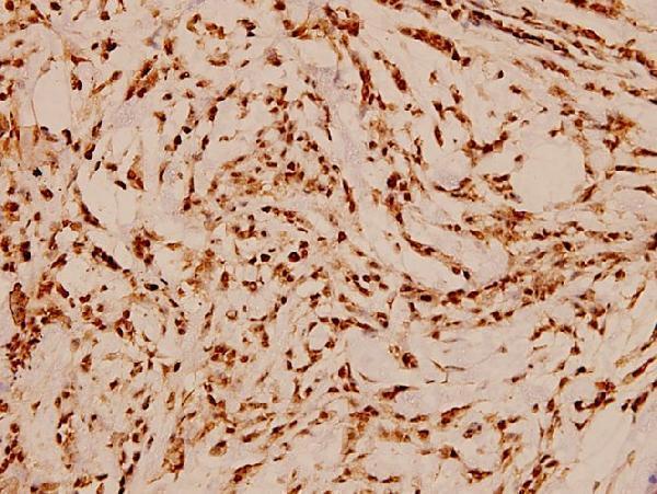 Immunohistochemistry (IHC) analyzes of HDAC3 (Y414) pAb in paraffin-embedded human breast carcinoma tissue at 1:100