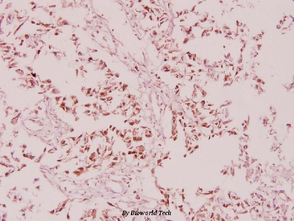 Immunohistochemistry (IHC) analyzes of p-eIF4B (S422) pAb in paraffin-embedded human breast carcinoma tissue at 1:100