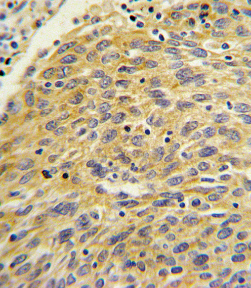 Formalin-fixed and paraffin-embedded human lung carcinoma with PLA2G4A Antibody (Center), which was peroxidase-conjugated to the secondary antibody, followed by DAB staining