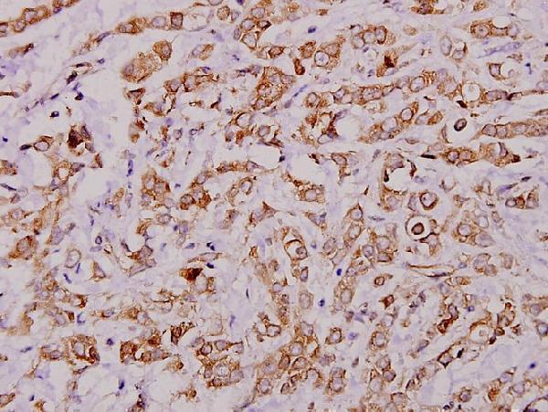 Immunohistochemistry (IHC) analyzes of c-PLA2 (N499) pAb in paraffin-embedded human breast carcinoma tissue at 1:100