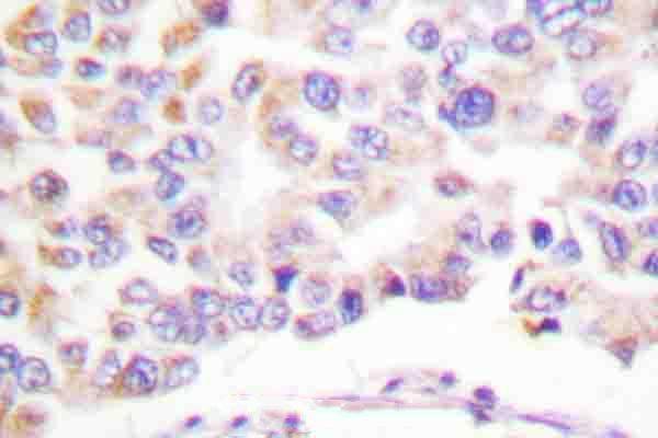 Immunohistochemistry (IHC) analyzes of p-cPLA2 (S505) pAb in paraffin-embedded human breast cancer tissue