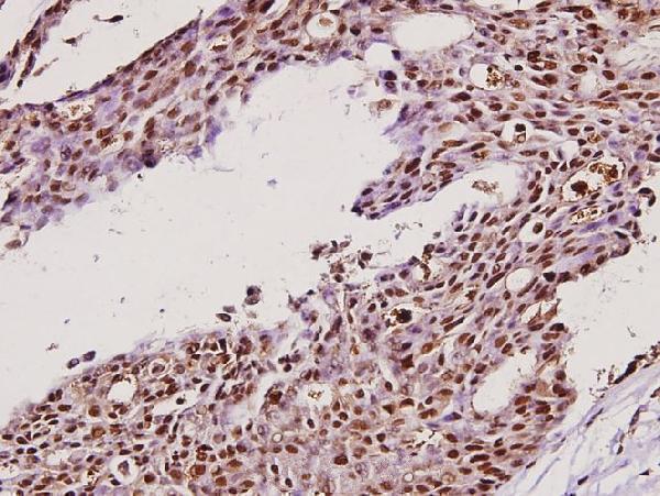 Immunohistochemistry (IHC) analyzes of IKKγ (H81) pAb in paraffin-embedded human breast carcinoma tissue at 1:100
