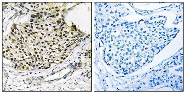 Immunohistochemistry analysis of paraffin-embedded human breast carcinoma, using IKK-gamma (Phospho-Ser31) Antibody