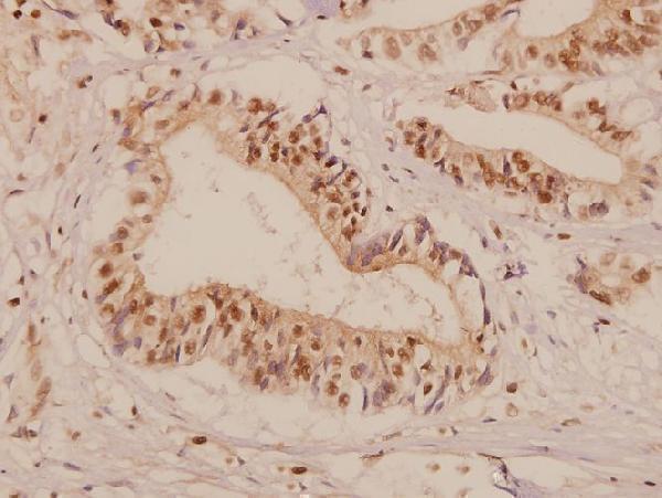 Immunohistochemistry (IHC) analyzes of GAS3 (A142) pAb in paraffin-embedded human colorectal carcinoma tissue at 1:50