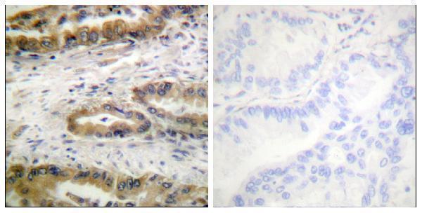 Immunohistochemistry analysis of paraffin-embedded human lung carcinoma, using VEGFR2 (Phospho-Tyr1054) Antibody