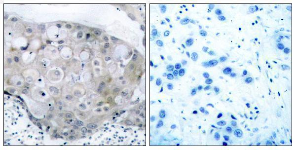 Immunohistochemistry analysis of paraffin-embedded human breast carcinoma, using VEGFR2 (Phospho-Tyr951) Antibody