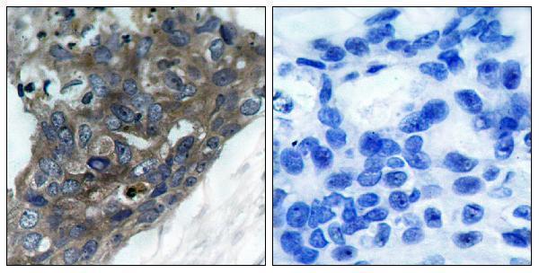 Immunohistochemistry analysis of paraffin-embedded human breast carcinoma tissue, using ASK1 Antibody