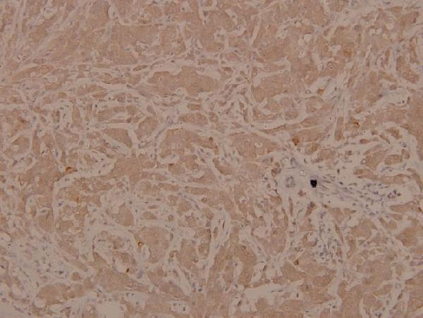 Immunohistochemistry (IHC) analyzes of ASK1 (phospho-S83) polyclonal antibody in paraffin-embedded human breast carcinoma tissue at 1:100