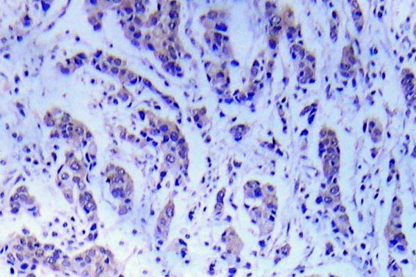 Immunohistochemistry (IHC) analyzes of ASK1 (S89) pAb in paraffin-embedded human breast carcinoma tissue