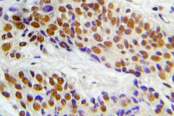 Immunohistochemistry (IHC) analyzes of p-ASK1 (S966) pAb in paraffin-embedded human lung adenocarcinoma tissue