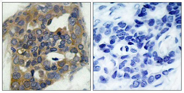 Immunohistochemistry analysis of paraffin-embedded human breast carcinoma, using ASK1 (Phospho-Ser966) Antibody