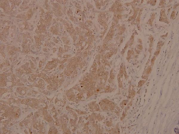 Immunohistochemistry (IHC) analyzes of p-ASK1 (S966) pAb in paraffin-embedded human breast carcinoma tissue at 1:100