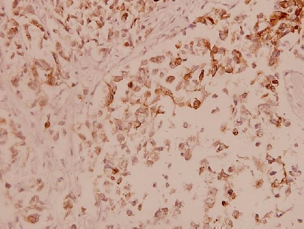 Immunohistochemistry (IHC) analyzes of ASK1 (T77) pAb in paraffin-embedded human breast carcinoma tissue at 1:100