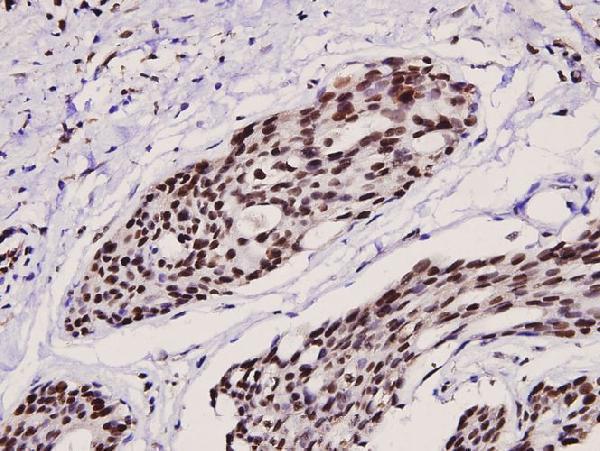 Immunohistochemistry (IHC) analyzes of p-Ets-1 (T38) pAb in paraffin-embedded human breast carcinoma tissue at 1:100